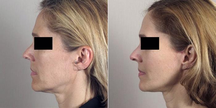 Facelift Case 1 Before & After View #1 | Paramus, New Jersey | Parker Center for Plastic Surgery