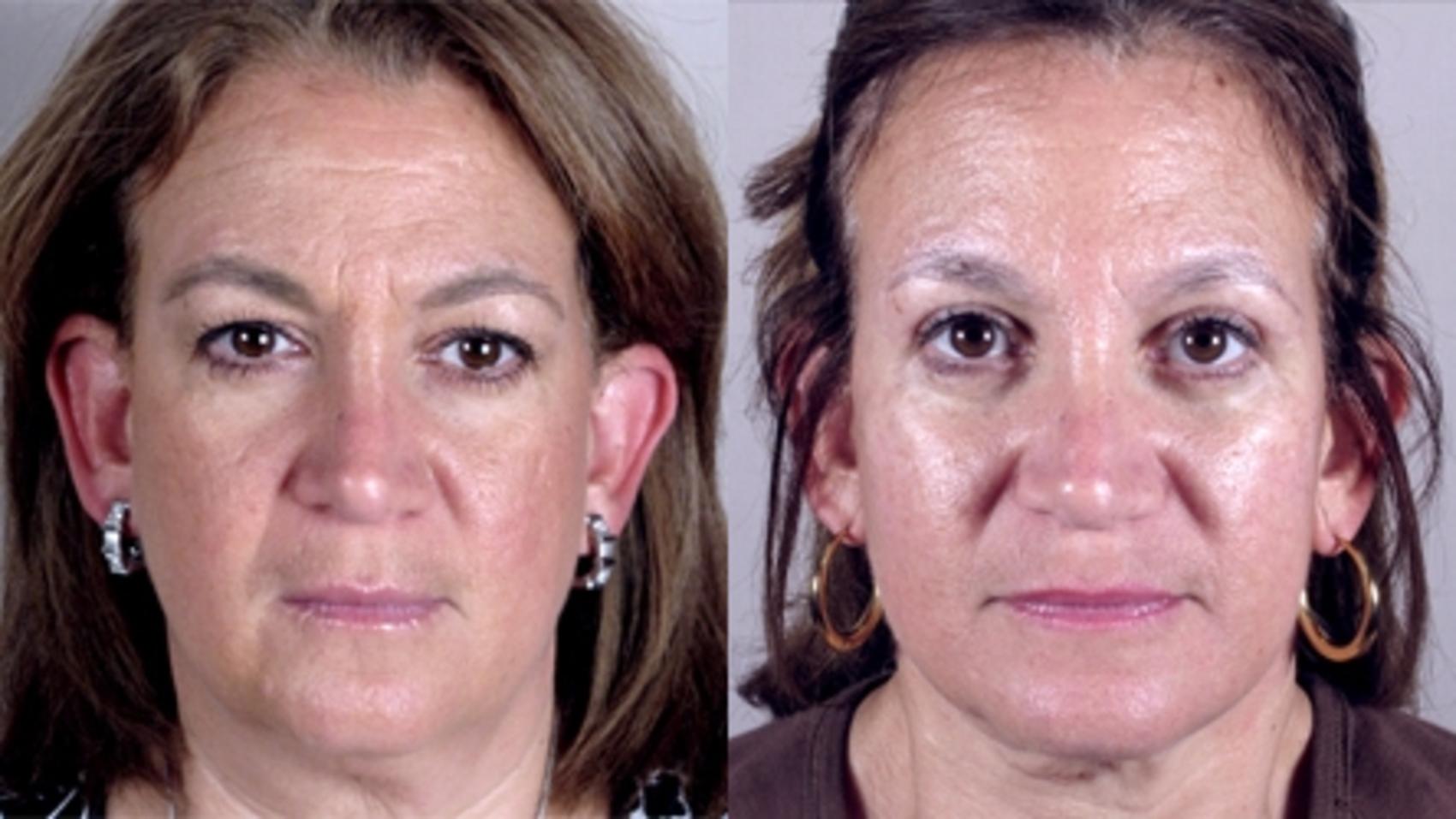 Facelift Case 11 Before & After View #1 | Paramus, New Jersey | Parker Center for Plastic Surgery