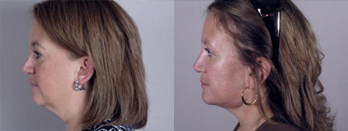 Facelift Case 11 Before & After View #2 | Paramus, New Jersey | Parker Center for Plastic Surgery