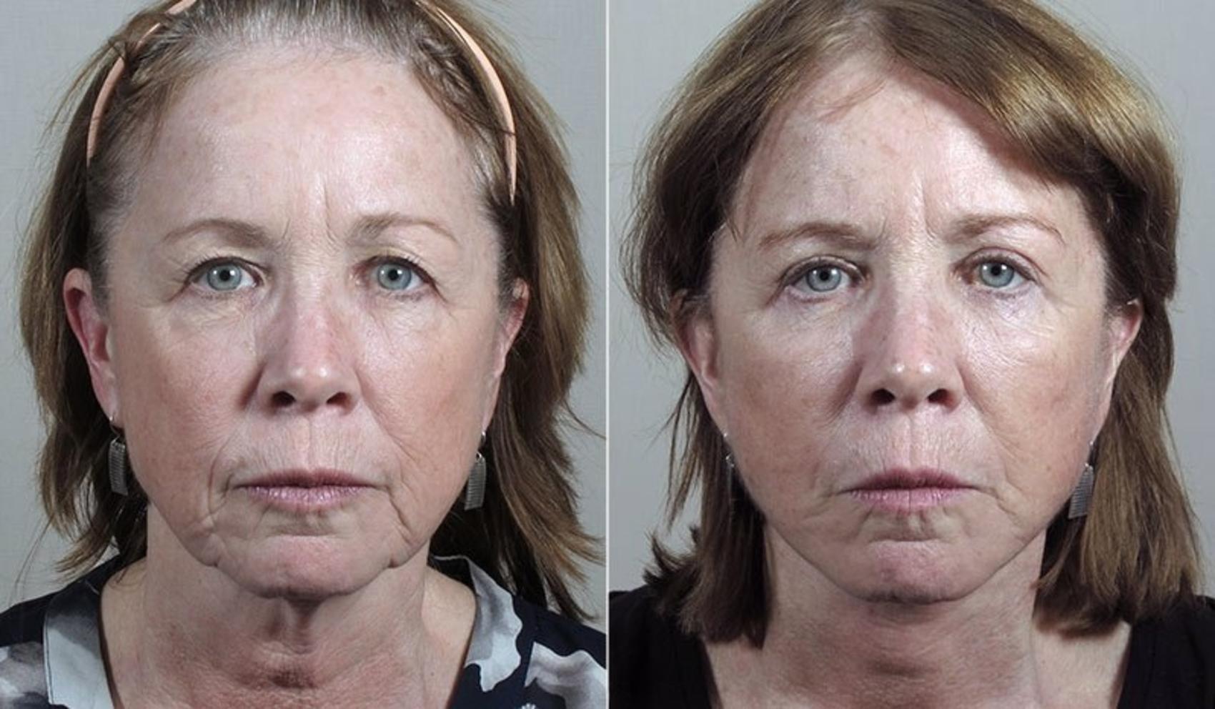 Facelift Case 1170 Before & After View 2 | Paramus, New Jersey | Parker Center for Plastic Surgery