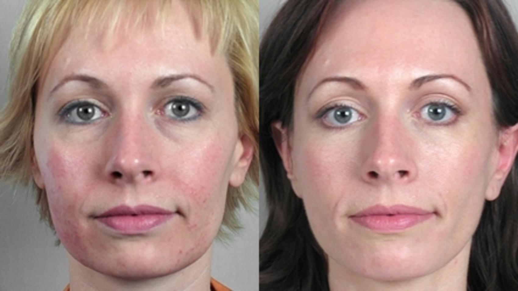Facelift Case 1172 Before & After View 1  | Paramus, New Jersey | Parker Center for Plastic Surgery
