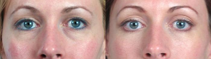 Facelift Case 1172 Before & After View 2 | Paramus, New Jersey | Parker Center for Plastic Surgery