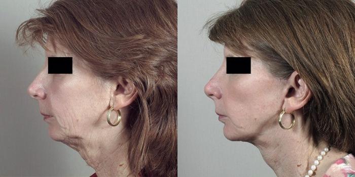 Facelift Case 1177 Before & After View 1  | Paramus, New Jersey | Parker Center for Plastic Surgery