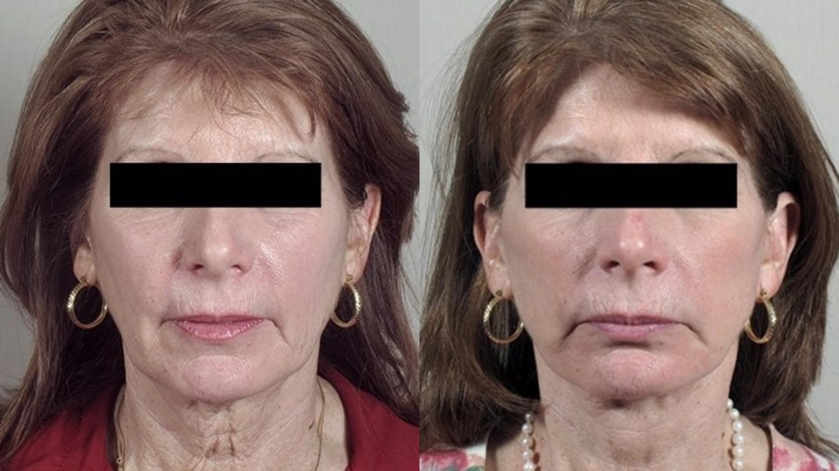 Facelift Case 1177 Before & After View 2 | Paramus, New Jersey | Parker Center for Plastic Surgery