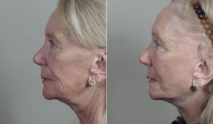 Facelift Case 1180 Before & After View 1  | Paramus, New Jersey | Parker Center for Plastic Surgery