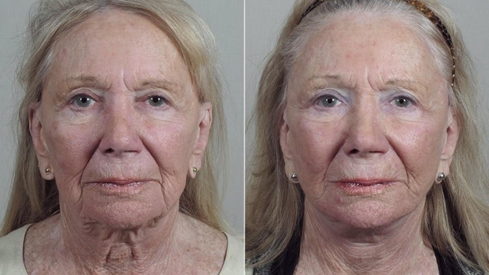 Facelift Case 1180 Before & After View 2 | Paramus, New Jersey | Parker Center for Plastic Surgery