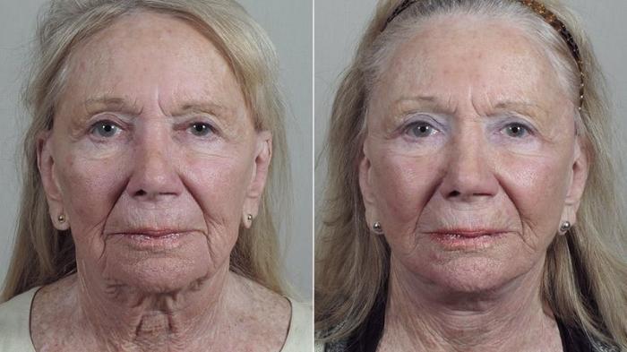 Facelift Case 1180 Before & After View 2 | Paramus, New Jersey | Parker Center for Plastic Surgery