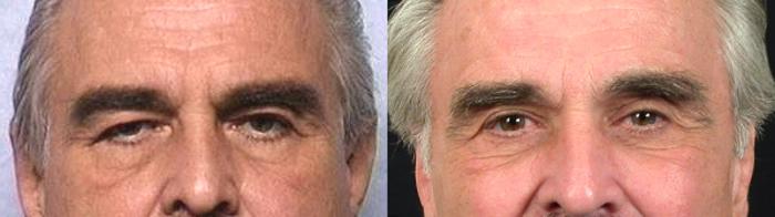 Facelift Case 12 Before & After View #3 | Paramus, New Jersey | Parker Center for Plastic Surgery