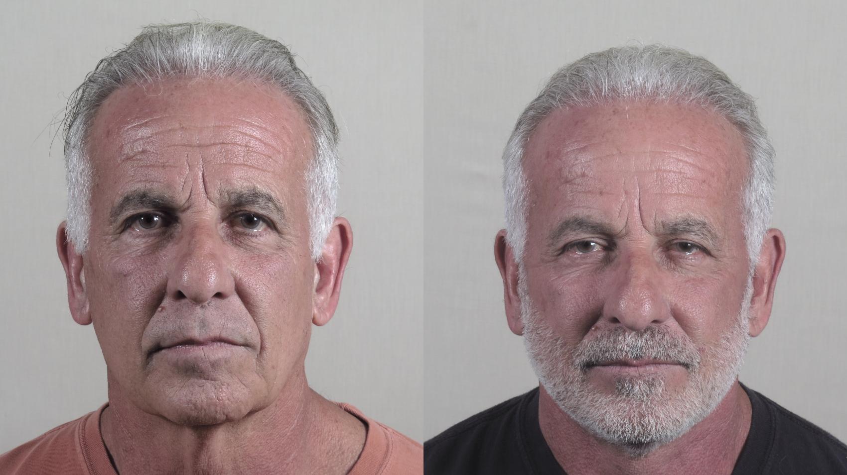 Facelift Case 1264 Before & After Front | Paramus, New Jersey | Parker Center for Plastic Surgery