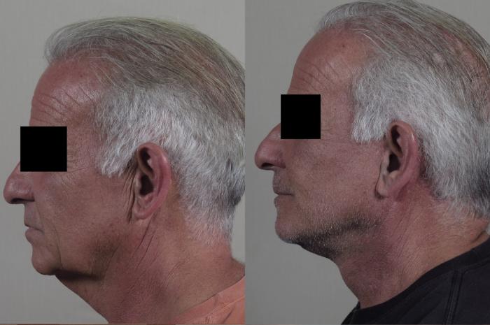 Facelift Case 1264 Before & After Left Side | Paramus, New Jersey | Parker Center for Plastic Surgery