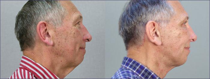 Facelift Case 13 Before & After View #2 | Paramus, New Jersey | Parker Center for Plastic Surgery