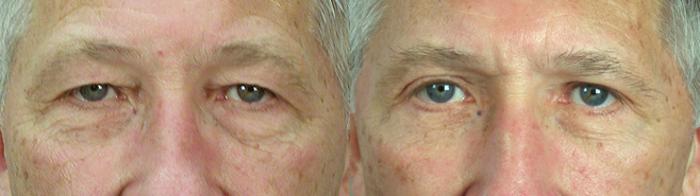 Facelift Case 13 Before & After View #3 | Paramus, New Jersey | Parker Center for Plastic Surgery