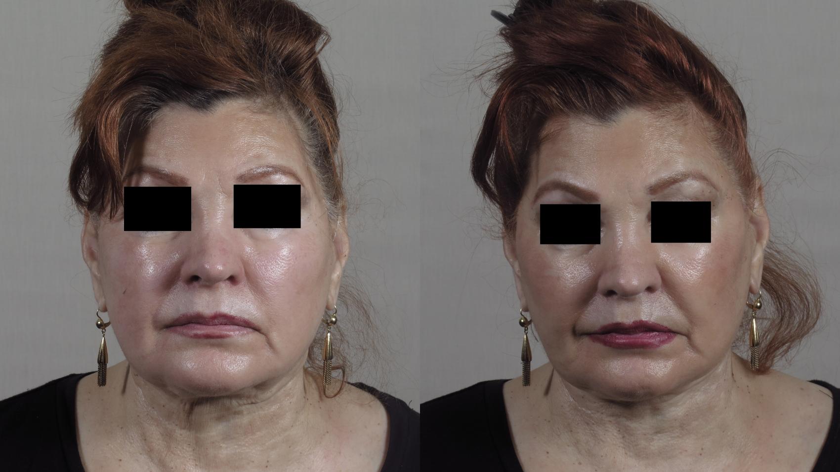 Facelift Case 1345 Before & After Front | Paramus, New Jersey | Parker Center for Plastic Surgery