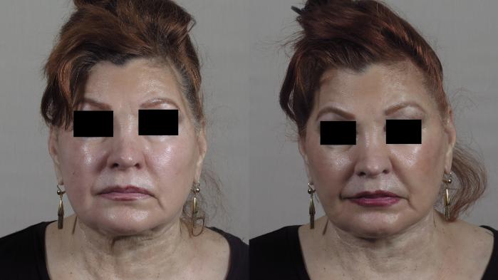 Facelift Case 1345 Before & After Front | Paramus, New Jersey | Parker Center for Plastic Surgery