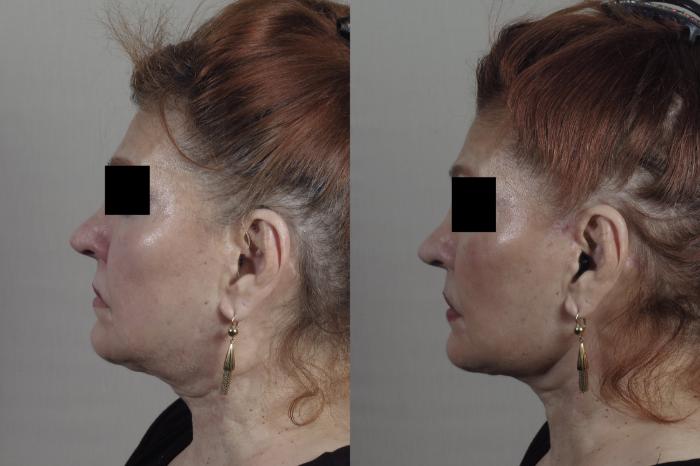 Facelift Case 1345 Before & After Left Side | Paramus, New Jersey | Parker Center for Plastic Surgery