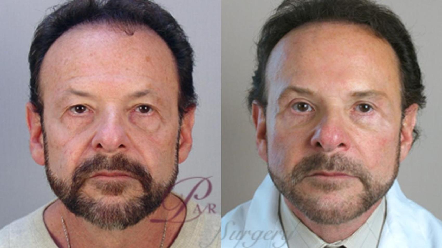 Facelift Case 1379 Before & After Front | Paramus, New Jersey | Parker Center for Plastic Surgery