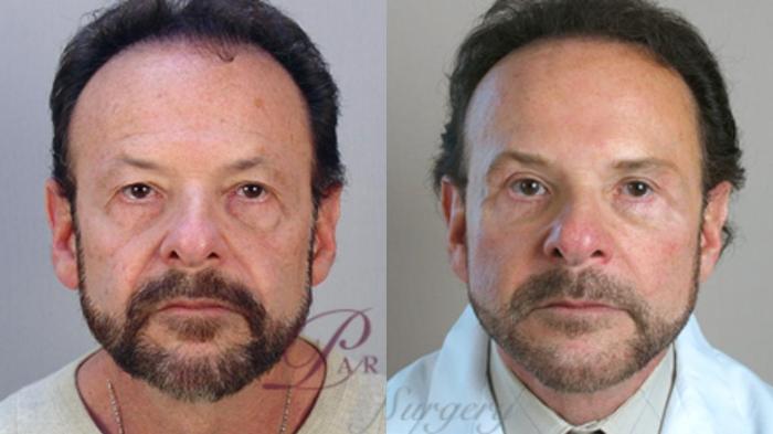 Facelift Case 1379 Before & After Front | Paramus, New Jersey | Parker Center for Plastic Surgery