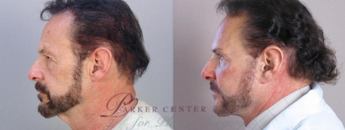 Facelift Case 1379 Before & After Left Side | Paramus, New Jersey | Parker Center for Plastic Surgery