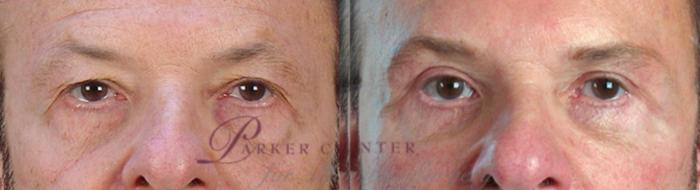Facelift Case 1379 Before & After zoomed in  | Paramus, New Jersey | Parker Center for Plastic Surgery