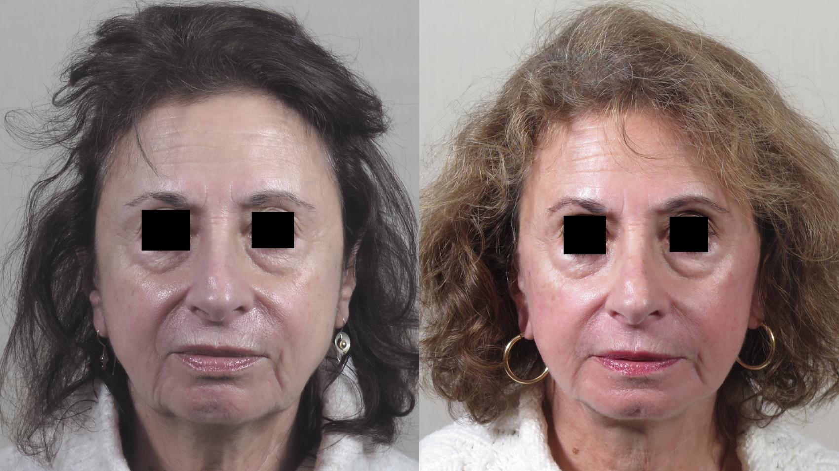 Facelift Case 1393 Before & After Front | Paramus, New Jersey | Parker Center for Plastic Surgery