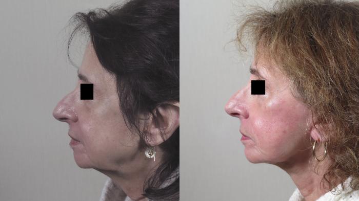 Facelift Case 1393 Before & After Side view | Paramus, New Jersey | Parker Center for Plastic Surgery
