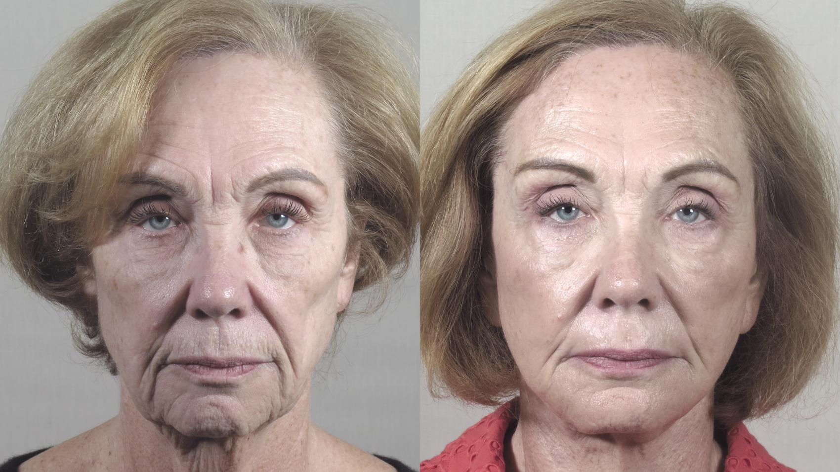 Facelift Case 1421 Before & After Front View | Paramus, New Jersey | Parker Center for Plastic Surgery