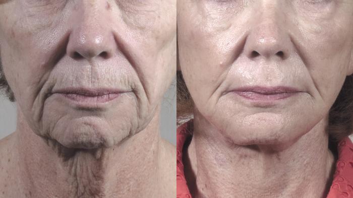 Facelift Case 1421 Before & After peri oral dermabrasion | Paramus, New Jersey | Parker Center for Plastic Surgery