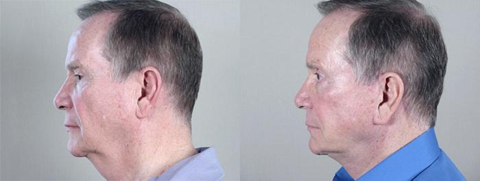 Facelift Case 15 Before & After View #2 | Paramus, New Jersey | Parker Center for Plastic Surgery