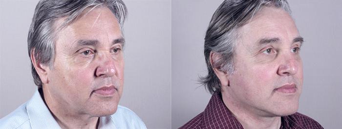 Facelift Case 16 Before & After View #2 | Paramus, New Jersey | Parker Center for Plastic Surgery