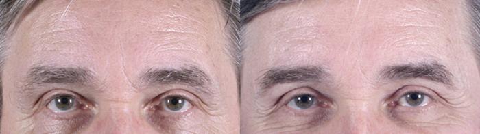 Facelift Case 16 Before & After View #3 | Paramus, New Jersey | Parker Center for Plastic Surgery