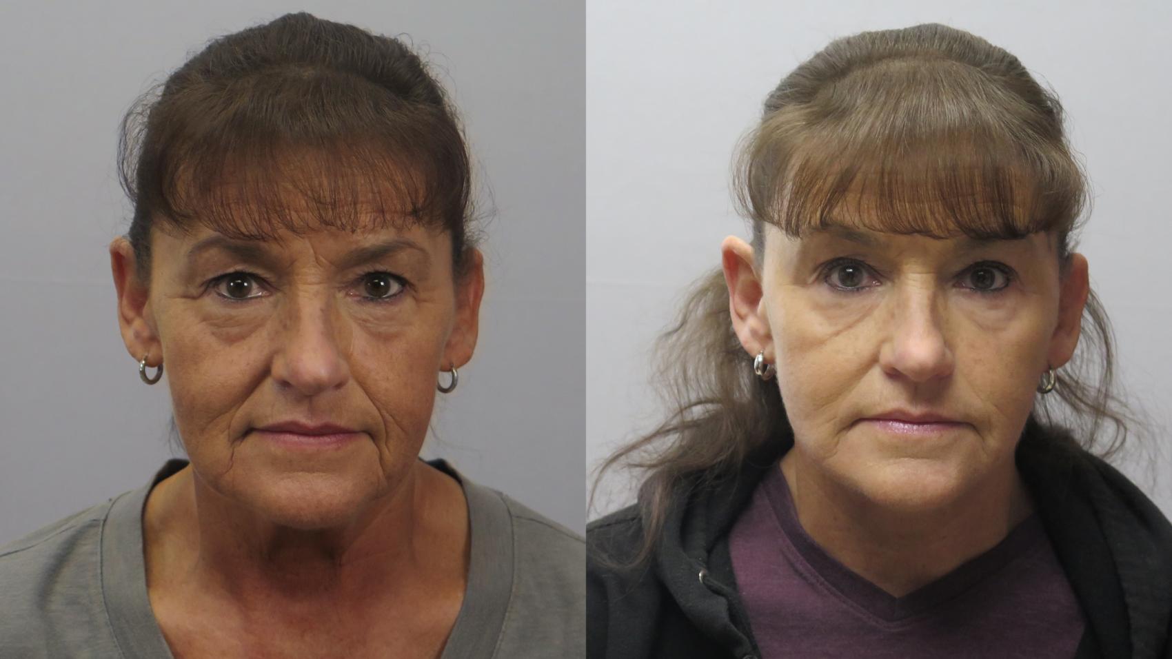 Facelift Case 1630 Before & After Front | Paramus, New Jersey | Parker Center for Plastic Surgery