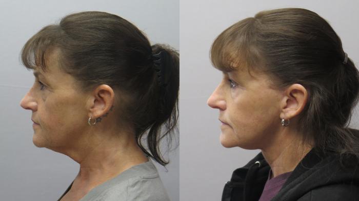 Facelift Case 1630 Before & After Left Side | Paramus, New Jersey | Parker Center for Plastic Surgery