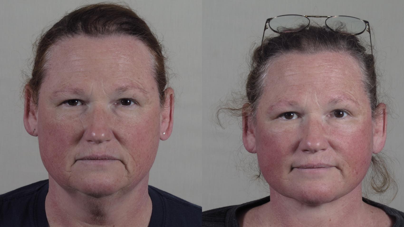 Facelift Case 1657 Before & After Front | Paramus, New Jersey | Parker Center for Plastic Surgery