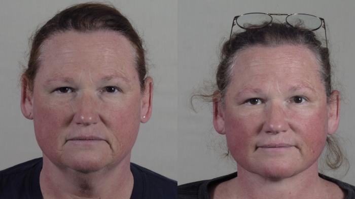 Facelift Case 1657 Before & After Front | Paramus, New Jersey | Parker Center for Plastic Surgery