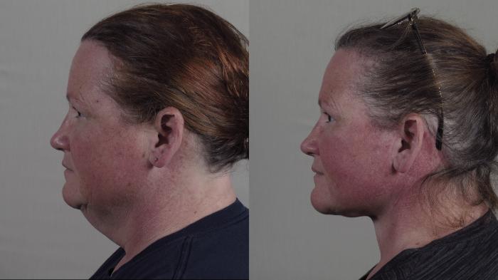 Facelift Case 1657 Before & After Left Side | Paramus, New Jersey | Parker Center for Plastic Surgery