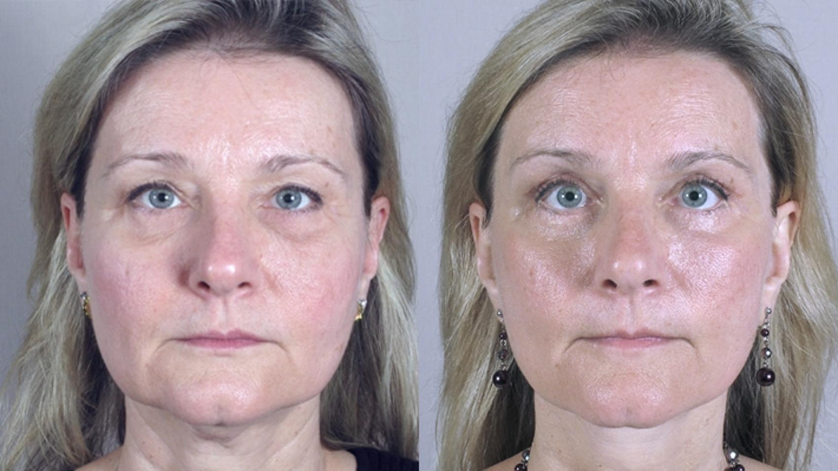 Facelift Case 17 Before & After View #1 | Paramus, New Jersey | Parker Center for Plastic Surgery