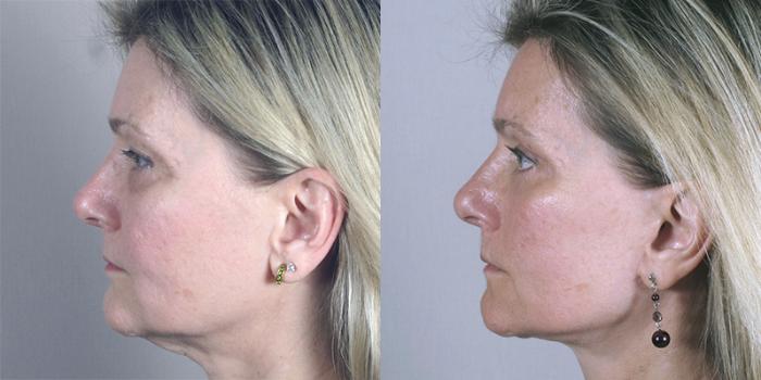 Facelift Case 17 Before & After View #2 | Paramus, New Jersey | Parker Center for Plastic Surgery