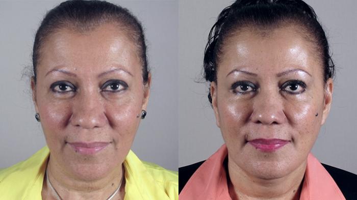 Facelift Case 19 Before & After View #1 | Paramus, New Jersey | Parker Center for Plastic Surgery