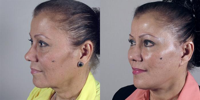Facelift Case 19 Before & After View #2 | Paramus, New Jersey | Parker Center for Plastic Surgery