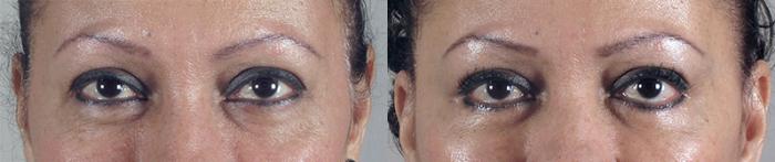 Facelift Case 19 Before & After View #3 | Paramus, New Jersey | Parker Center for Plastic Surgery