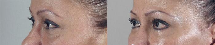 Facelift Case 19 Before & After View #4 | Paramus, New Jersey | Parker Center for Plastic Surgery