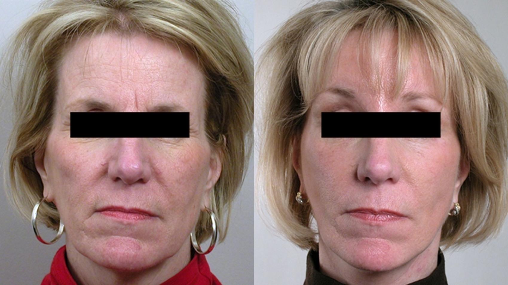 Facelift Case 20 Before & After View #1 | Paramus, New Jersey | Parker Center for Plastic Surgery