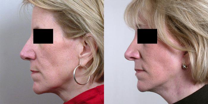 Facelift Case 20 Before & After View #2 | Paramus, New Jersey | Parker Center for Plastic Surgery