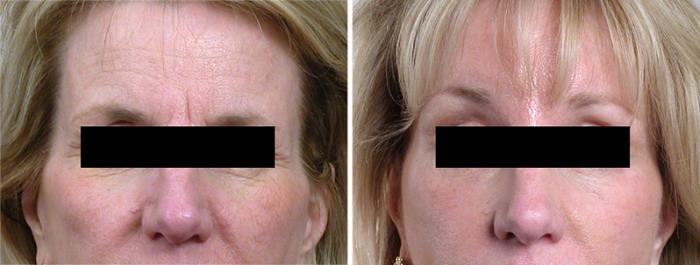 Facelift Case 20 Before & After View #3 | Paramus, New Jersey | Parker Center for Plastic Surgery