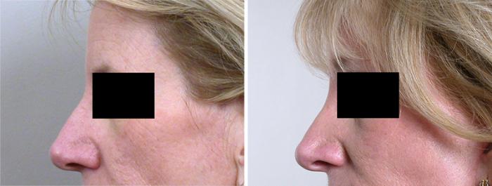 Facelift Case 20 Before & After View #4 | Paramus, New Jersey | Parker Center for Plastic Surgery