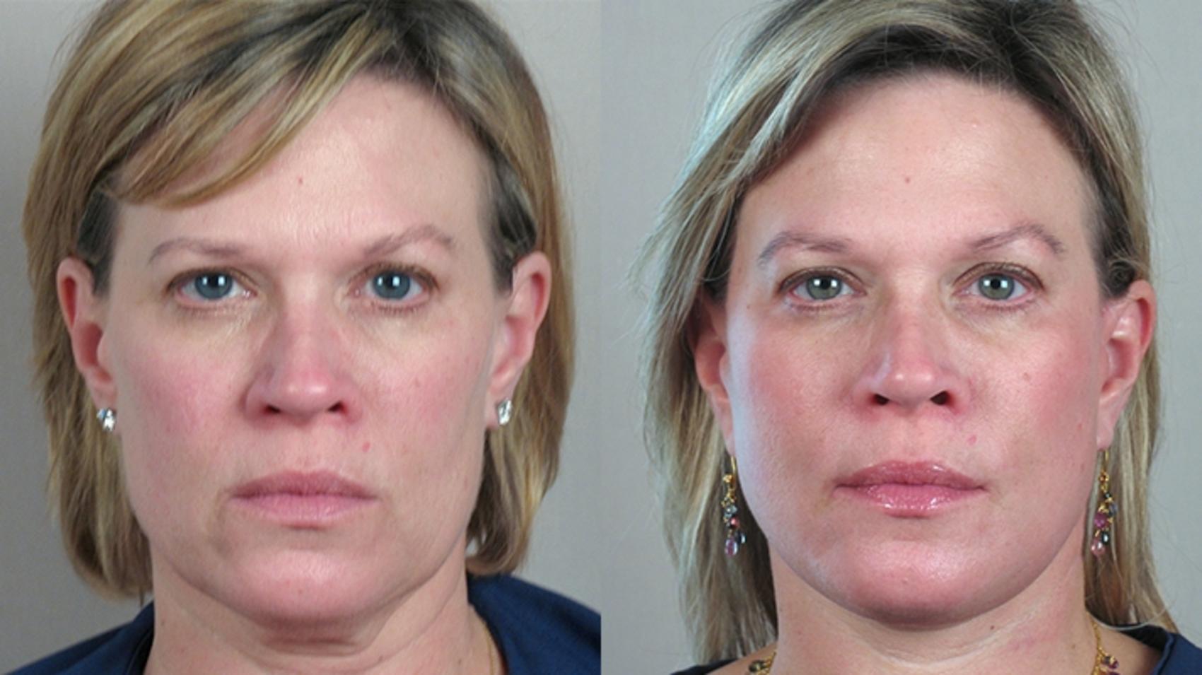 Facelift Case 21 Before & After View #1 | Paramus, New Jersey | Parker Center for Plastic Surgery