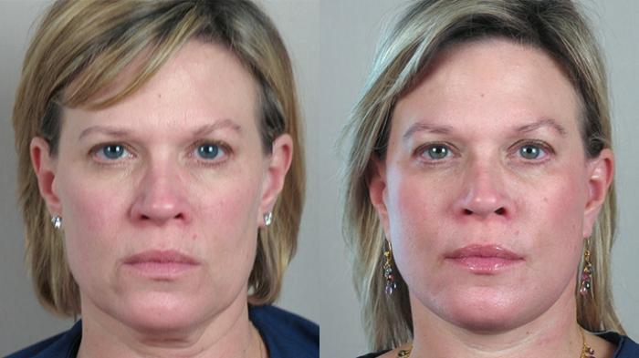 Facelift Case 21 Before & After View #1 | Paramus, New Jersey | Parker Center for Plastic Surgery