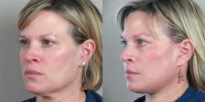 Facelift Case 21 Before & After View #2 | Paramus, New Jersey | Parker Center for Plastic Surgery