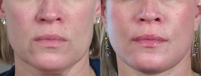 Facelift Case 21 Before & After View #3 | Paramus, New Jersey | Parker Center for Plastic Surgery