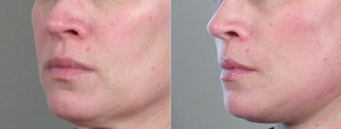 Facelift Case 21 Before & After View #4 | Paramus, New Jersey | Parker Center for Plastic Surgery